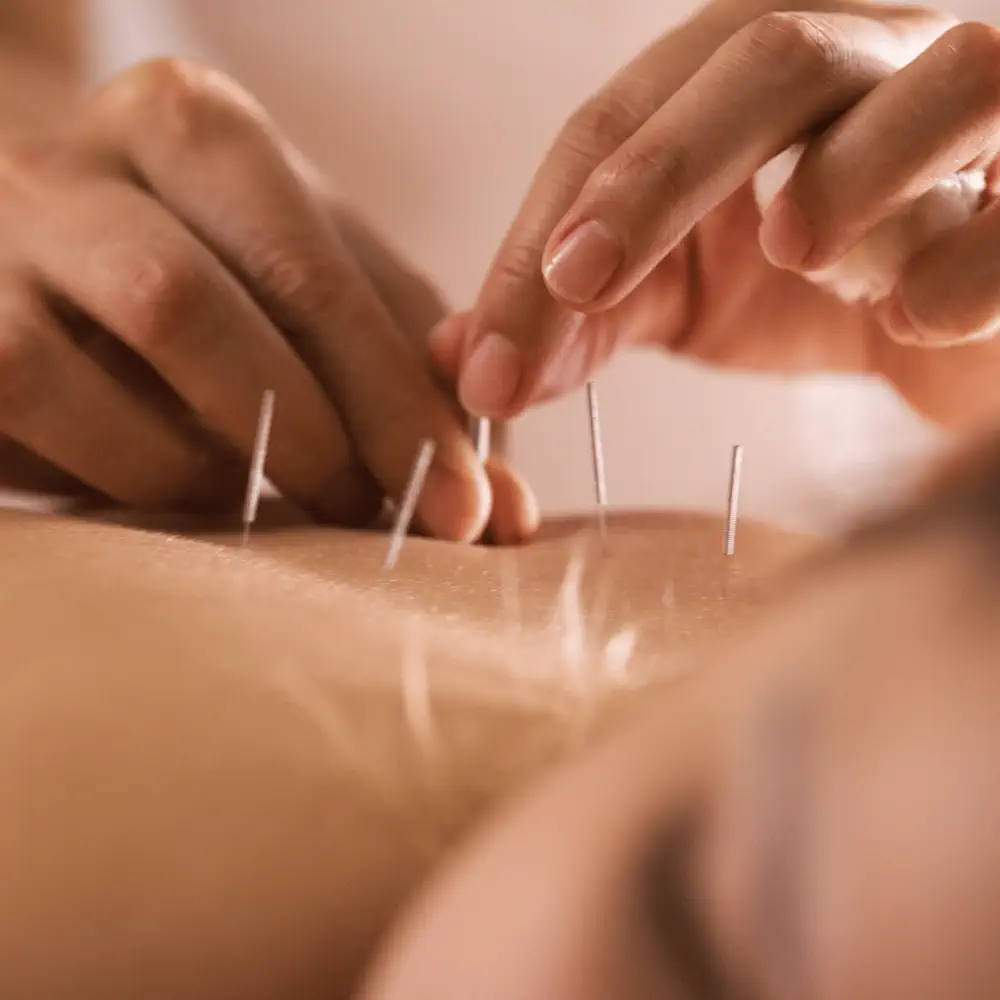 Acupuncture and Cupping